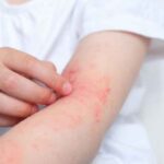 Resources for Parents Navigating Childhood Eczema Challenges