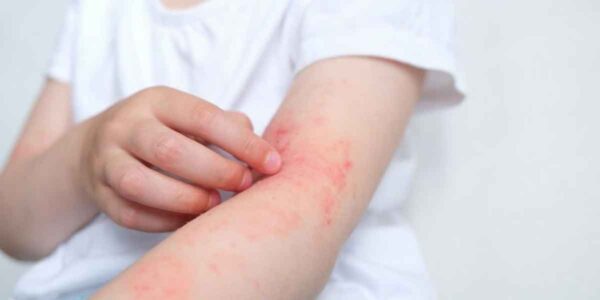 Resources for Parents Navigating Childhood Eczema Challenges
