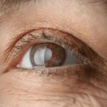 The Connection Between Cataracts and Aging