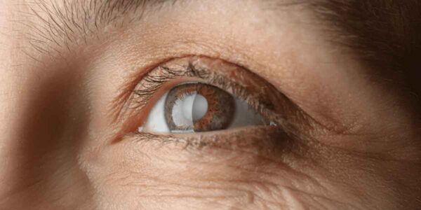 The Connection Between Cataracts and Aging